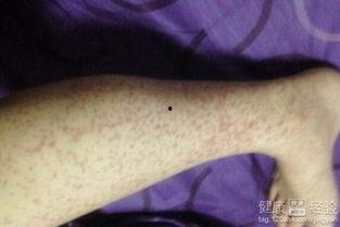 过敏性紫癜可以吃瓜吗,瓜类食物的适宜与禁忌